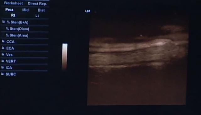 Nova tehnika otkrivanja bolesti krvnih sudova spasava živote